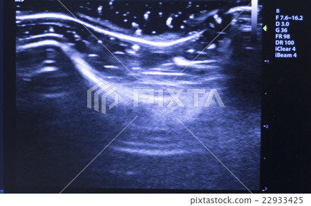 Ultrasound ecograph EPI ecography Ultrasound ecograph EPI ecography 22933425