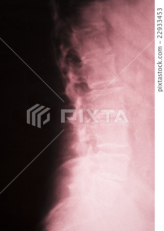 Spine back neck xray scan 22933453
