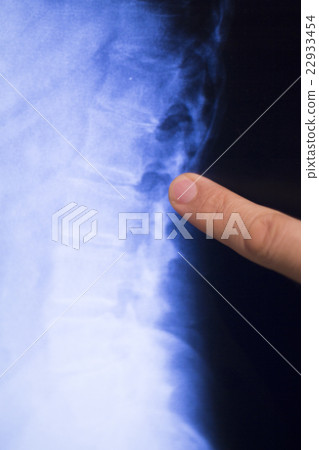 Spine back neck xray scan 22933454