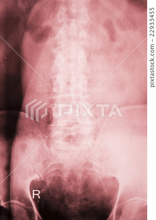 Hip joint surgical implant xray scan Hip joint surgical implant xray scan 22933455