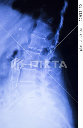 Spine back neck xray scan Spine back neck xray scan 22933460