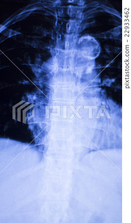 Spine back neck xray scan 22933462