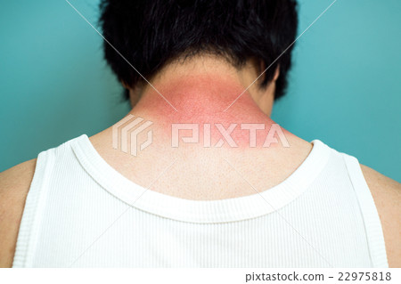 Sunburned neck Sunburned neck 22975818