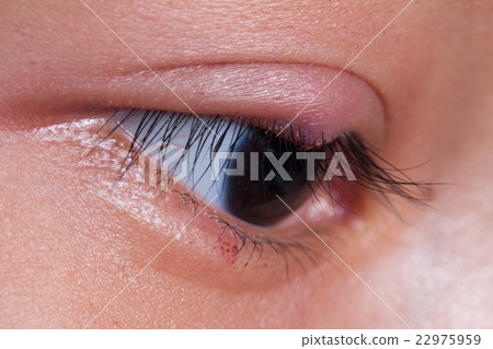 right upper eye lid abscess, stye or hordeolum right upper eye lid abscess, stye or hordeolum 22975959
