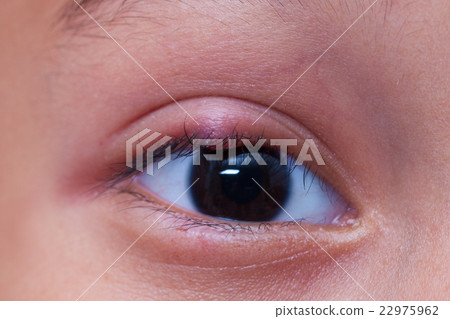 right upper eye lid abscess, stye or hordeolum 22975962