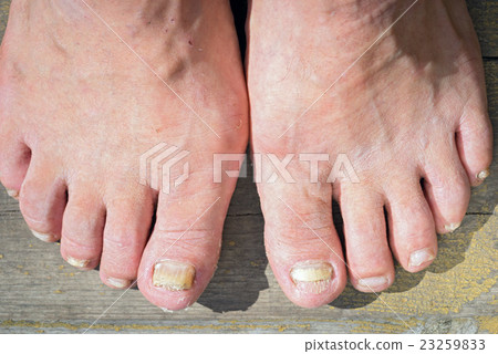 A toenail fungus at the peak of the infection. A toenail fungus at the peak of the infection. 23259833