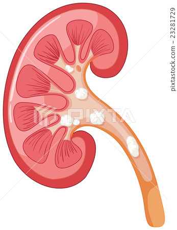 Diagram of kidney having problem 23281729