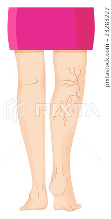 Varicose veins on human legs Varicose veins on human legs 23283227
