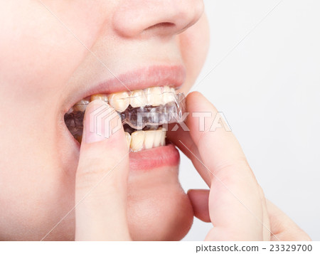 young woman puts transparent aligner 23329700