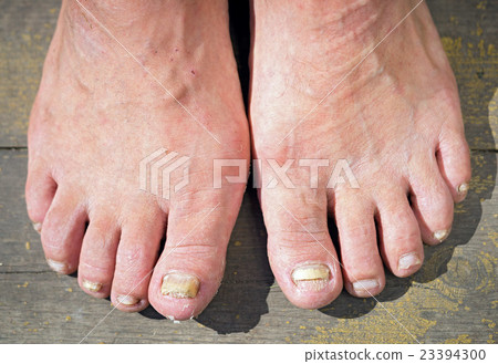 onychomycosis with fungal nail infection onychomycosis with fungal nail infection 23394300
