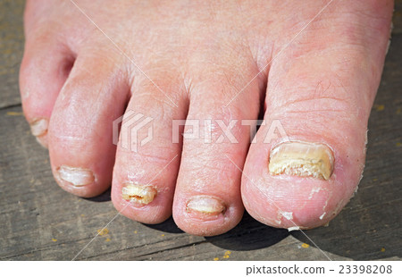 Fungus Infection on Nails of Man's Foot 23398208