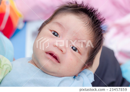 Little asian newborn with many rash on face 23457859
