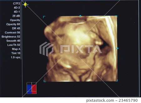 Baby echo 26 weeks pregnant 23465790