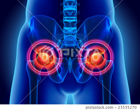 Hip painful skeleton x-ray, 3D illustration. 23535270