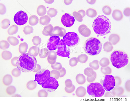 Leukemia cells in blood smear 23550643