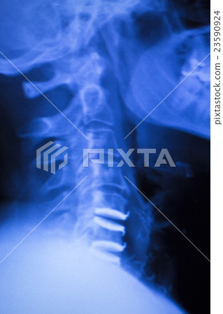 Neck and spine injury xray scan 23590924