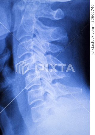 Neck and spine injury xray scan Neck and spine injury xray scan 23603746