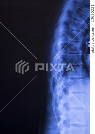 Neck and spine injury xray scan 23620221