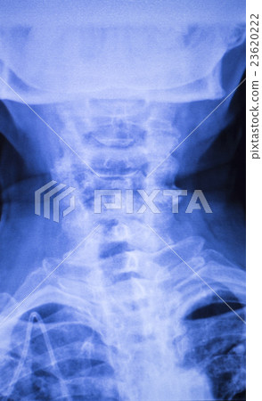 Neck and spine injury xray scan Neck and spine injury xray scan 23620222
