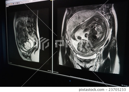 盆腔胎兒MRI 盆腔胎兒MRI 23705233