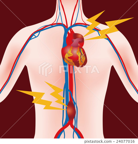 主動脈瘤圖像例證 24077016