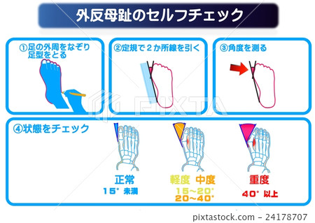 Self-check of hallux valgus 24178707