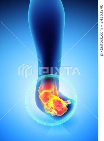 Ankle painful - skeleton x-ray. Ankle painful - skeleton x-ray. 24363240
