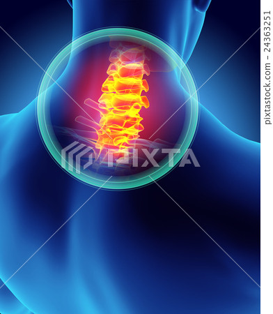 Neck painful - cervica spine, 3D illustration. Neck painful - cervica spine, 3D illustration. 24363251