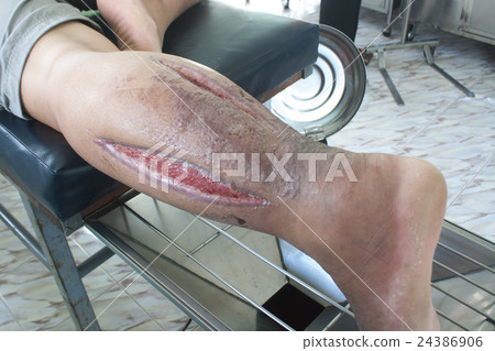 Wound infection Wound infection 24386906