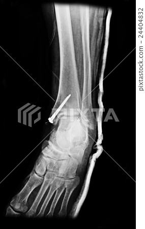Ankle foot joint orthopedic titanium metal plate Ankle foot joint orthopedic titanium metal plate 24404832