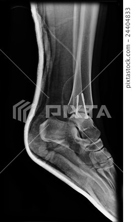 Ankle foot joint orthopedic titanium metal plate Ankle foot joint orthopedic titanium metal plate 24404833