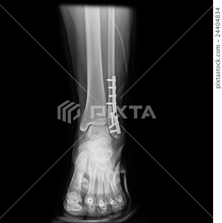 Ankle foot joint orthopedic titanium metal plate Ankle foot joint orthopedic titanium metal plate 24404834
