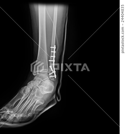 Ankle foot joint orthopedic titanium metal plate Ankle foot joint orthopedic titanium metal plate 24404835