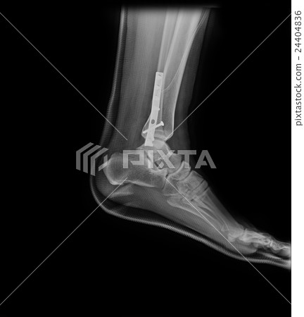 Ankle foot joint orthopedic titanium metal plate 24404836