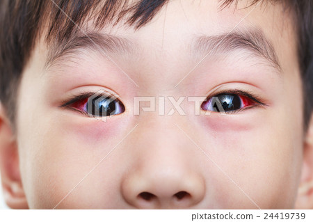 Closeup of chronic conjunctivitis with a red iris. 24419739