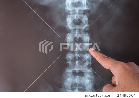 X-Ray image of human for a medical diagnosis X-Ray image of human for a medical diagnosis 24490564