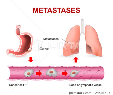 Cancer cells, cancer foci and Metastases 24501393