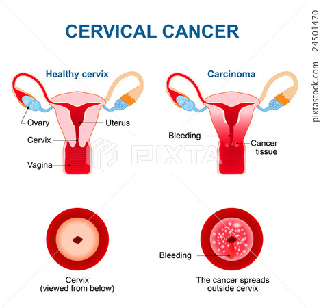 Cervical Cancer. Carcinoma of Cervix Cervical Cancer. Carcinoma of Cervix 24501470
