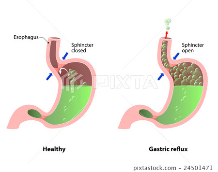 Belching, Heartburn or reflux 24501471
