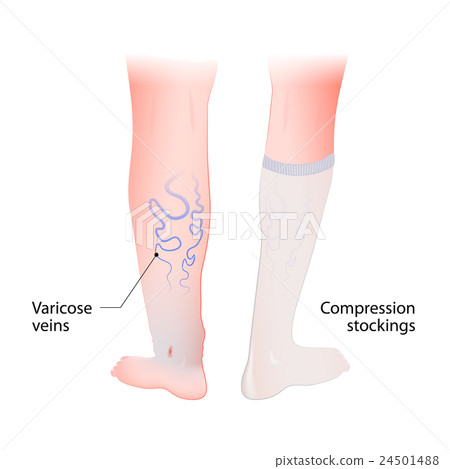 compression stockings for varicose veins 24501488