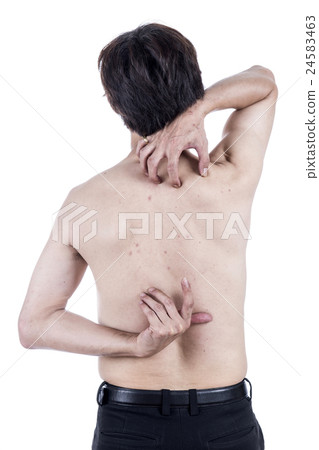 Men with acne rash at the back and neck. 24583463