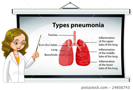 Doctor explaining types of pneumonia Doctor explaining types of pneumonia 24608743