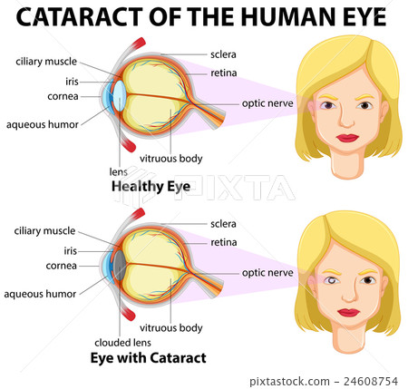 Diagram showing eyes with cataract Diagram showing eyes with cataract 24608754