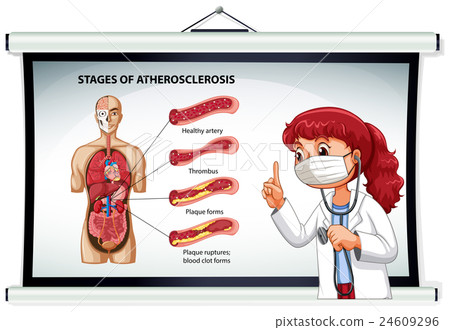 Doctor explaining stages of atherosclerosis - Stock Illustration ...