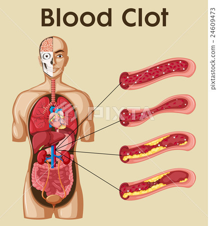 Diagram showing blood clot in human 24609473