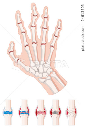 Rheumatoid arthritis diagram on white - Stock Illustration [24613503 ...