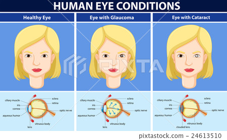 Diagram showing human eye conditions 24613510