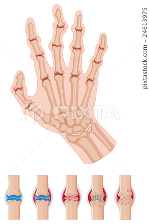 Rheumatoid arthritis in human hands 24613975