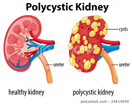 Diagram showing polycystic kidney 24614040