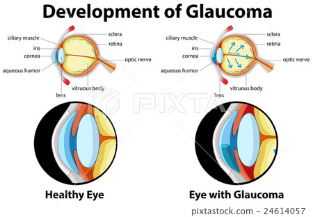 Diagram showing development of glaucoma Diagram showing development of glaucoma 24614057